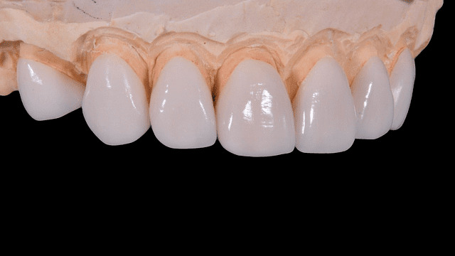 porcelain veneers