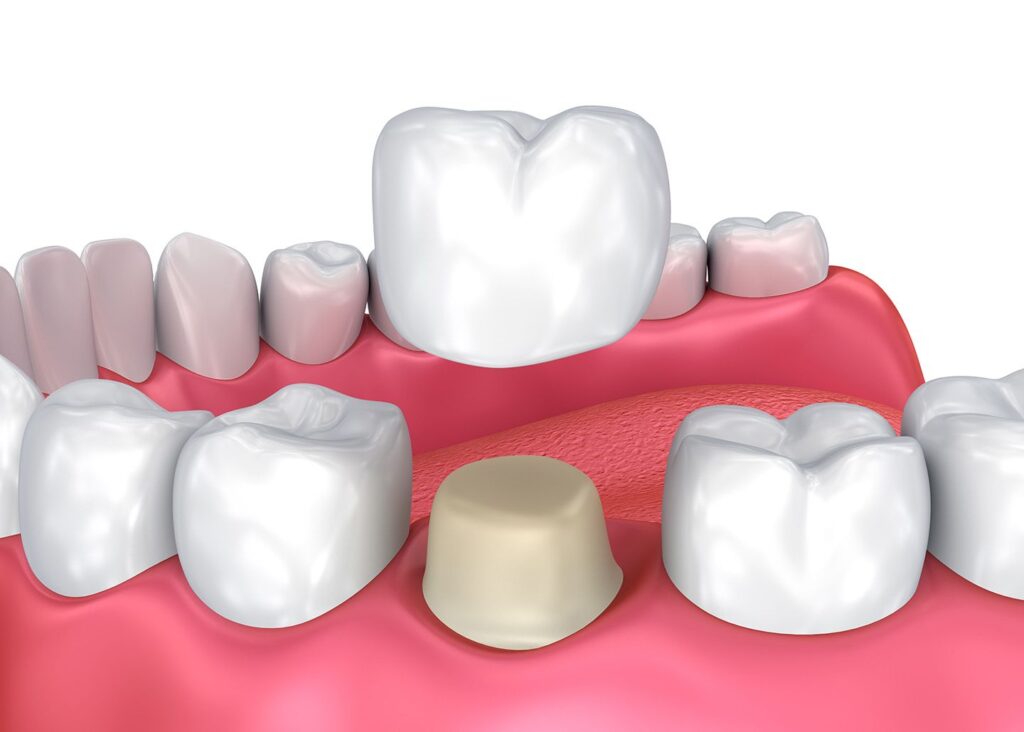 Dental crowns