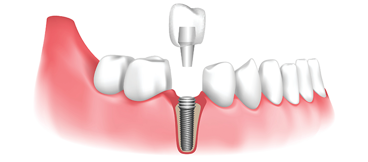 Power of Dental Implants